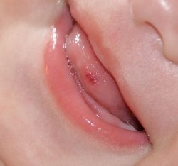 Прищи на язике, под ним и у основания. Лечение и причини появления