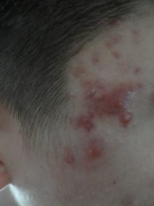 Вот как выглядят на висках прыщи Вот как выглядят на висках прыщи