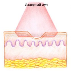 Удаление рубцов после прыщей лазером Удаление рубцов после прыщей лазером