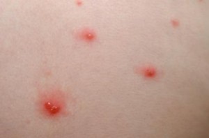 Можно ли папилломы прижигать йодом