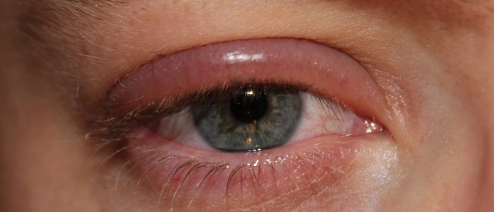 Чирей на глазу: как лечить, причини появления, симптоми