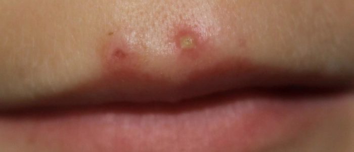 Фурункул на губе у детей и взрослих: причини, осложнения, как лечить