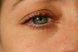Чирей на глазу: как лечить, причини появления, симптоми