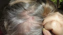 Фурункул на голове в волосах: лечение, причини
