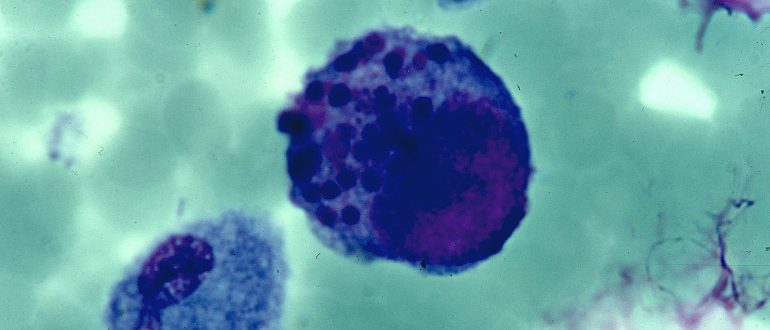 Varicella pneumonia adults