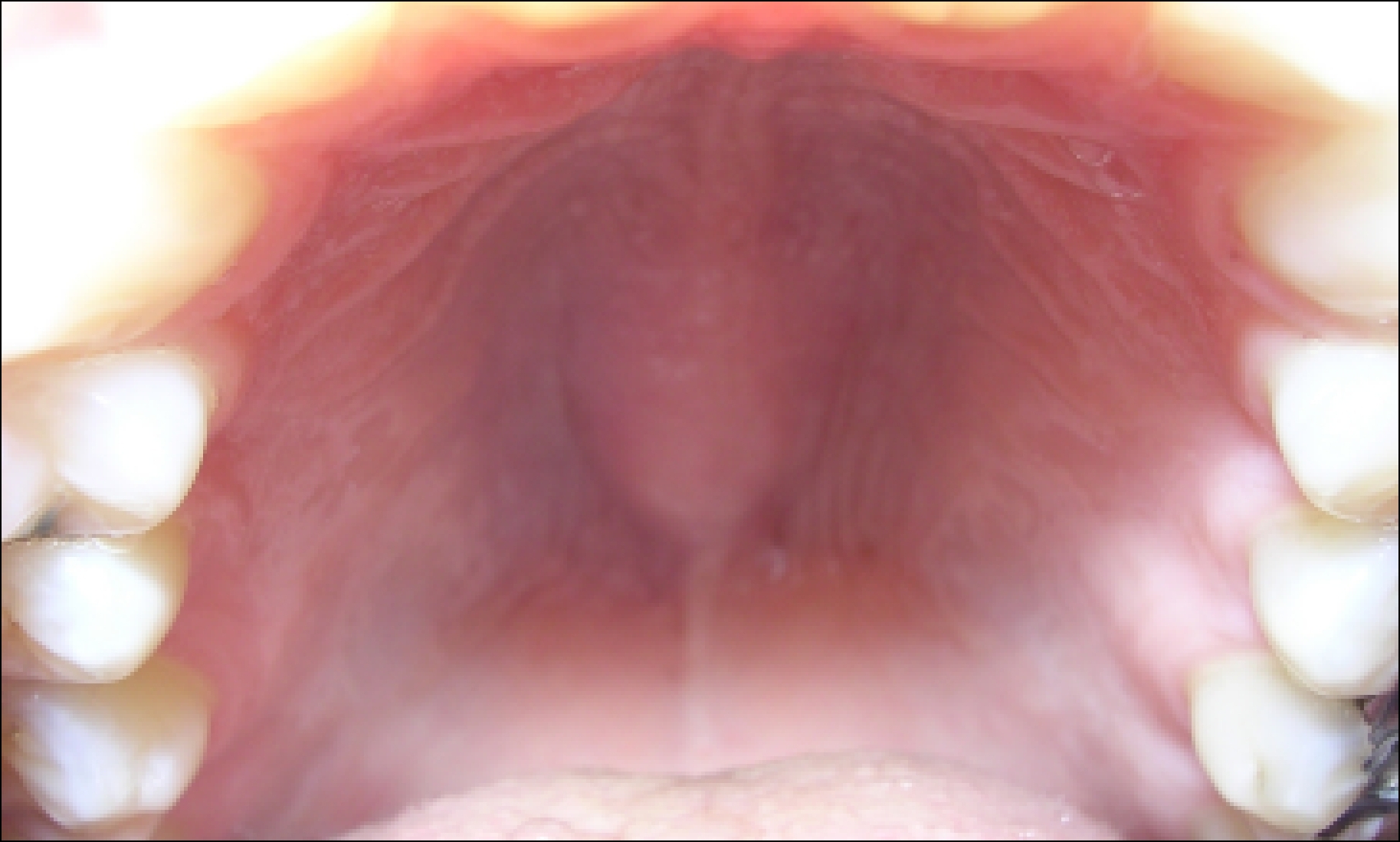 Диагностика и лечение шишки на небе во рту