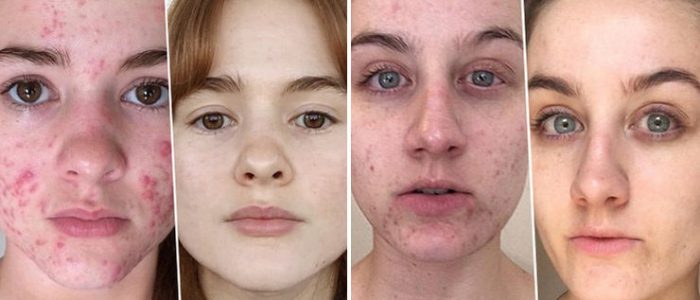 Лечение и симптомы розацеа на лице