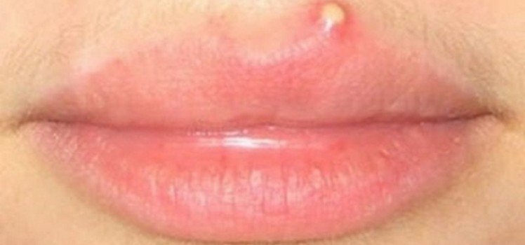 Прыщи над губой: причины, способы лечения, профилактика