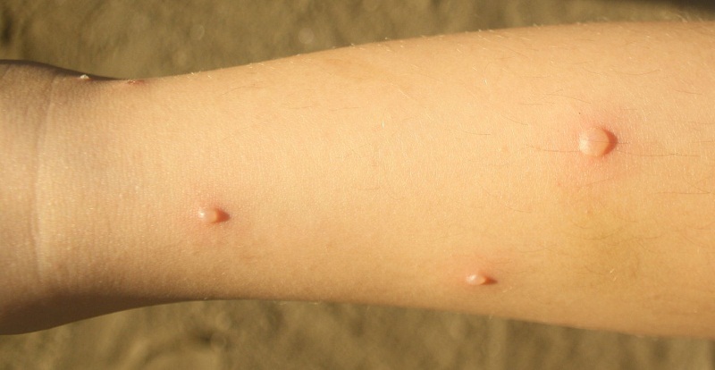 Виды аллергии на коже, симптомы